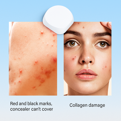 MXYE™ – LED Light Therapy Pimple Patch